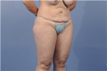 Tummy Tuck Before Photo by Trent Douglas, MD; Greenbrae, CA - Case 31401