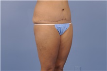 Tummy Tuck After Photo by Trent Douglas, MD; Greenbrae, CA - Case 31402