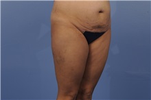 Tummy Tuck Before Photo by Trent Douglas, MD; Greenbrae, CA - Case 31402