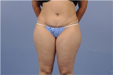 Tummy Tuck After Photo by Trent Douglas, MD; Greenbrae, CA - Case 31403