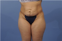 Tummy Tuck Before Photo by Trent Douglas, MD; Greenbrae, CA - Case 31403