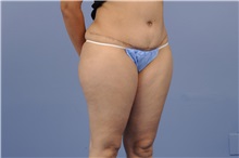 Tummy Tuck After Photo by Trent Douglas, MD; Greenbrae, CA - Case 31403