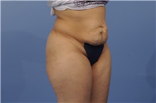 Tummy Tuck Before Photo by Trent Douglas, MD; Greenbrae, CA - Case 31403