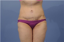 Tummy Tuck After Photo by Trent Douglas, MD; Greenbrae, CA - Case 31404