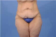 Tummy Tuck Before Photo by Trent Douglas, MD; Greenbrae, CA - Case 31404