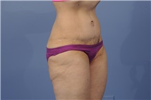 Tummy Tuck After Photo by Trent Douglas, MD; Greenbrae, CA - Case 31404