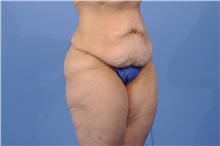 Tummy Tuck Before Photo by Trent Douglas, MD; Greenbrae, CA - Case 31404