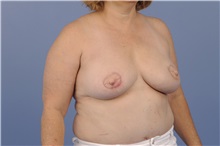 Breast Reconstruction After Photo by Trent Douglas, MD; Greenbrae, CA - Case 31406