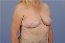 Breast Reconstruction After Photo by Trent Douglas, MD; Greenbrae, CA - Case 31408