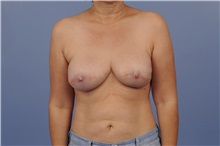 Breast Reconstruction After Photo by Trent Douglas, MD; Greenbrae, CA - Case 31409