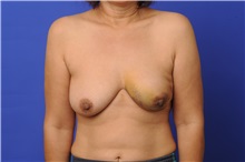 Breast Reconstruction Before Photo by Trent Douglas, MD; Greenbrae, CA - Case 31409