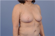 Breast Reduction After Photo by Trent Douglas, MD; Greenbrae, CA - Case 31410