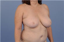 Breast Reduction Before Photo by Trent Douglas, MD; Greenbrae, CA - Case 31410