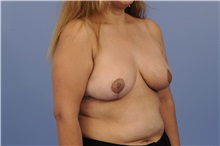 Breast Reduction After Photo by Trent Douglas, MD; Greenbrae, CA - Case 31411