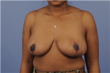 Breast Reduction After Photo by Trent Douglas, MD; Greenbrae, CA - Case 31413