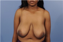 Breast Reduction Before Photo by Trent Douglas, MD; Greenbrae, CA - Case 31413