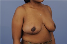 Breast Reduction After Photo by Trent Douglas, MD; Greenbrae, CA - Case 31413