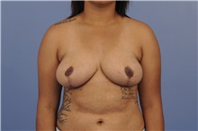 Breast Reduction After Photo by Trent Douglas, MD; Greenbrae, CA - Case 31414