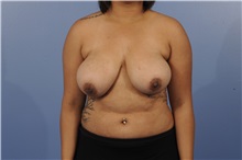 Breast Reduction Before Photo by Trent Douglas, MD; Greenbrae, CA - Case 31414