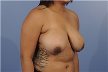 Breast Reduction Before Photo by Trent Douglas, MD; Greenbrae, CA - Case 31414