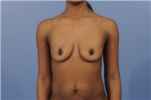 Body Contouring Before Photo by Trent Douglas, MD; Greenbrae, CA - Case 31415