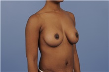 Body Contouring After Photo by Trent Douglas, MD; Greenbrae, CA - Case 31415