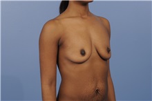 Body Contouring Before Photo by Trent Douglas, MD; Greenbrae, CA - Case 31415