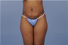 Body Contouring After Photo by Trent Douglas, MD; Greenbrae, CA - Case 31415