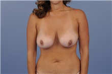 Body Contouring Before Photo by Trent Douglas, MD; Greenbrae, CA - Case 31416