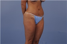 Body Contouring After Photo by Trent Douglas, MD; Greenbrae, CA - Case 31416