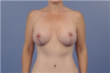 Body Contouring After Photo by Trent Douglas, MD; Greenbrae, CA - Case 31417