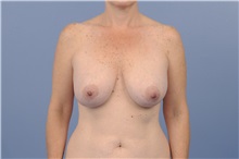 Body Contouring Before Photo by Trent Douglas, MD; Greenbrae, CA - Case 31417