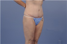 Body Contouring After Photo by Trent Douglas, MD; Greenbrae, CA - Case 31417