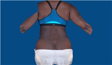 Liposuction After Photo by Trent Douglas, MD; Greenbrae, CA - Case 32809