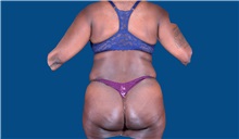 Liposuction Before Photo by Trent Douglas, MD; Greenbrae, CA - Case 32809