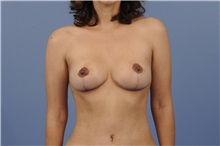 Breast Lift After Photo by Trent Douglas, MD; Greenbrae, CA - Case 32810