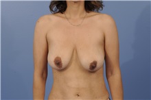 Breast Lift Before Photo by Trent Douglas, MD; Greenbrae, CA - Case 32810