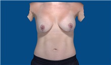 Breast Augmentation After Photo by Trent Douglas, MD; Greenbrae, CA - Case 32871