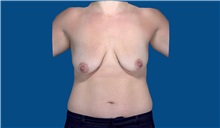 Breast Augmentation Before Photo by Trent Douglas, MD; Greenbrae, CA - Case 32871