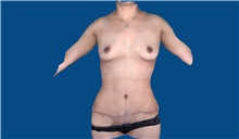 Tummy Tuck After Photo by Trent Douglas, MD; Greenbrae, CA - Case 32872