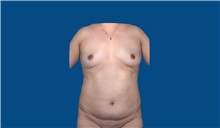 Tummy Tuck Before Photo by Trent Douglas, MD; Greenbrae, CA - Case 32872