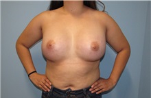 Breast Augmentation After Photo by Trent Douglas, MD; Greenbrae, CA - Case 33858