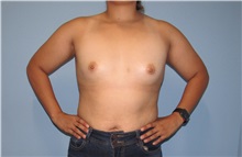 Breast Augmentation Before Photo by Trent Douglas, MD; Greenbrae, CA - Case 33858