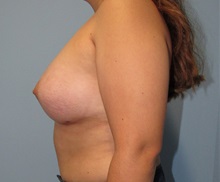 Breast Augmentation After Photo by Trent Douglas, MD; Greenbrae, CA - Case 33858
