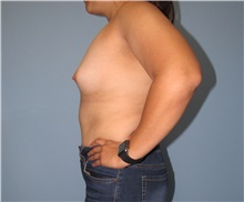 Breast Augmentation Before Photo by Trent Douglas, MD; Greenbrae, CA - Case 33858