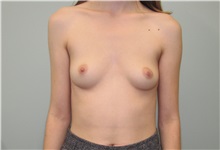 Breast Augmentation Before Photo by Trent Douglas, MD; Greenbrae, CA - Case 35109