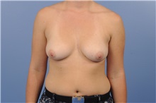 Breast Augmentation Before Photo by Trent Douglas, MD; Greenbrae, CA - Case 35161