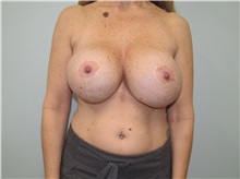 Breast Implant Removal Before Photo by Trent Douglas, MD; Greenbrae, CA - Case 35869