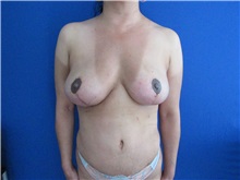 Breast Implant Removal After Photo by Trent Douglas, MD; Greenbrae, CA - Case 35870