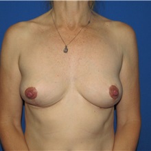 Breast Implant Removal After Photo by Trent Douglas, MD; Greenbrae, CA - Case 35920